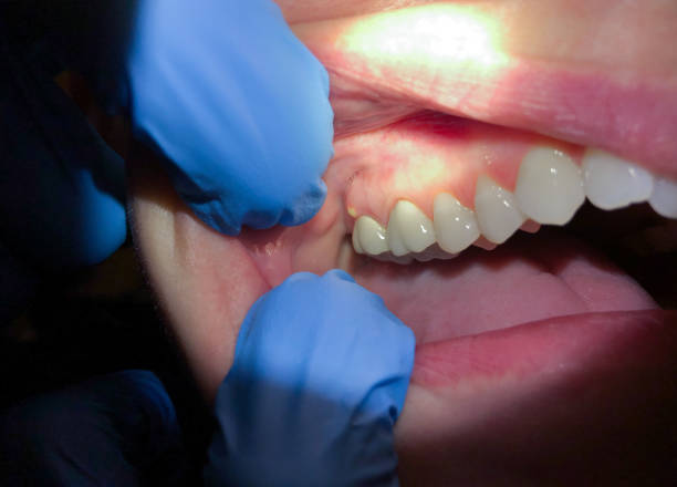 Best Dentist for Tooth Abscess  in Bayou Vista, LA